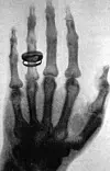 Das vielleicht berühmteste Röntgenbild zeigt die Hand von Albert von Köllikers linker Hand, die Wilhelm Röntgen bei einem öffentlichen Vortrag präsentierte.